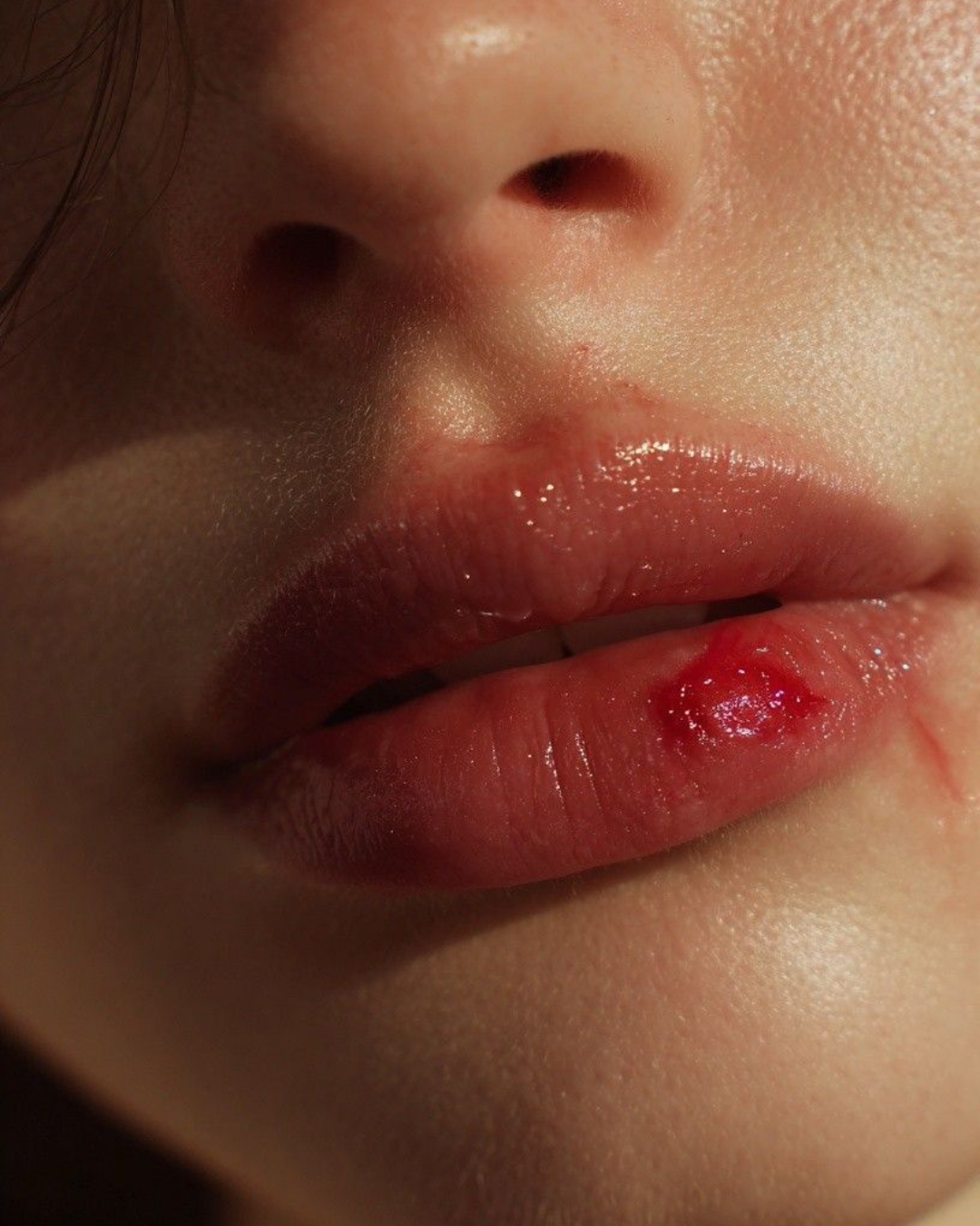 Cold Sores
