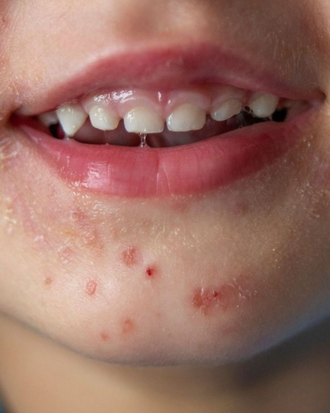 Hand, Foot, Mouth Disease