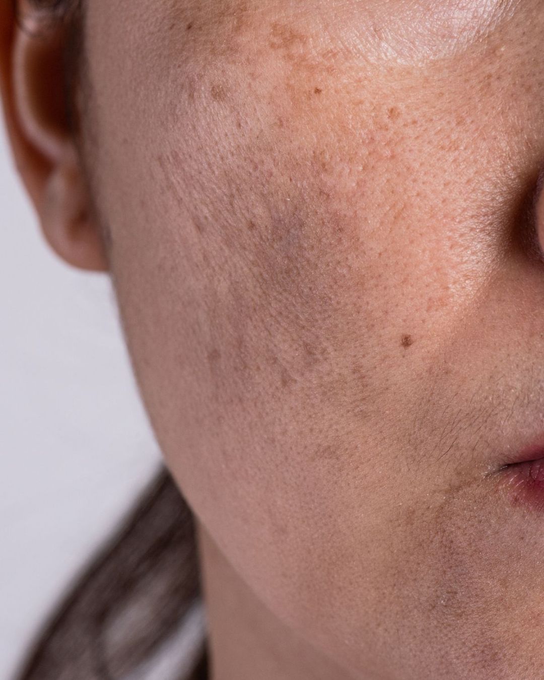 Melasma: How to Get Rid of it for Good